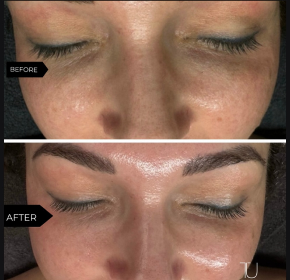 💎 Add ON Juve Eyes Microneedling