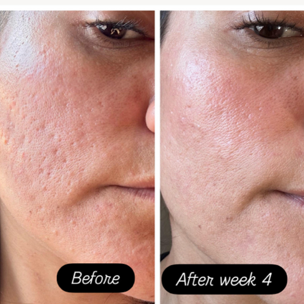 🌿Skin Revive💉 at Queensmade Esthetics in Wilmington, NC