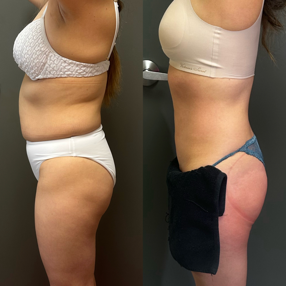 Criomodeling Fat Reduction