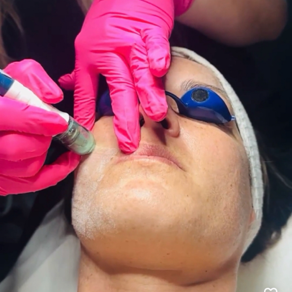 Crystal Microdermabrasion Facial at Everglow Esthetics in Brevard, NC
