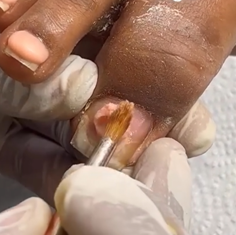 Acrylic Toe Repair