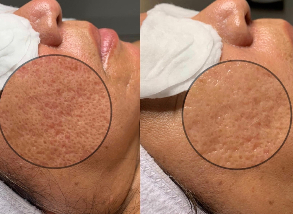 Ageless Angel Facial