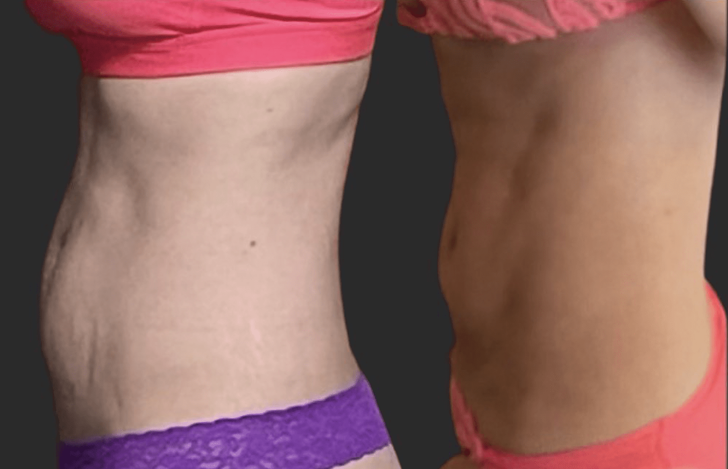 EMS Sculpting (6)