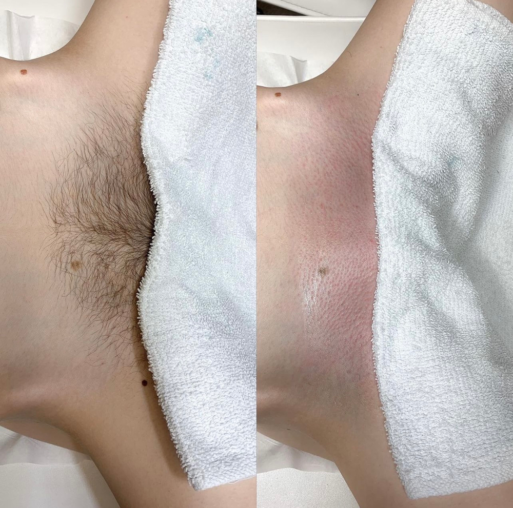 Brazilian Wax