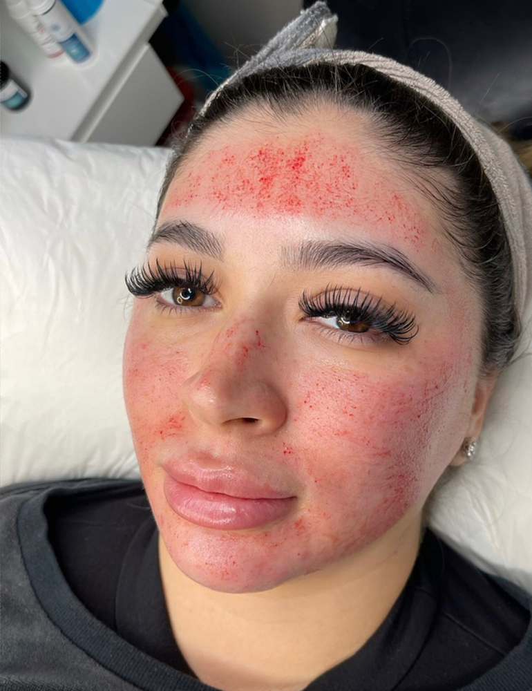 Microneedling Face Includes Neck