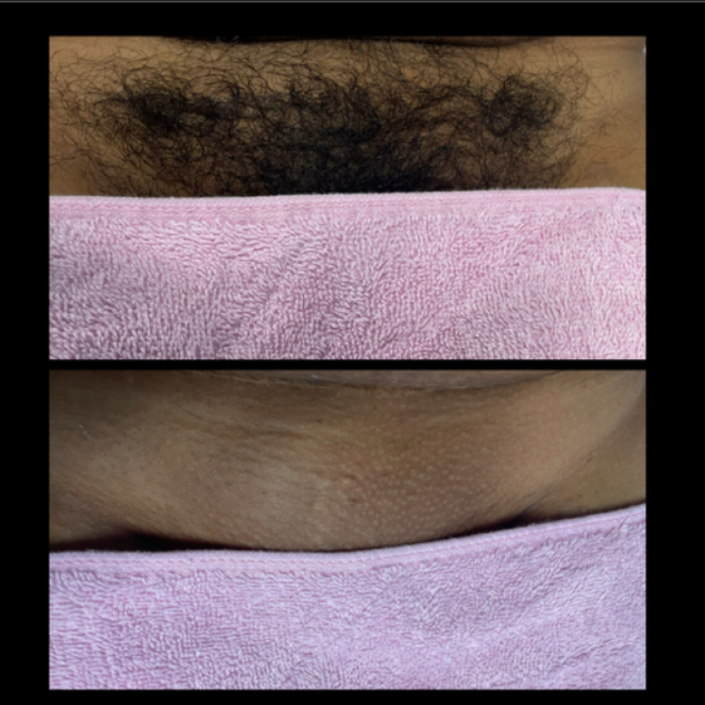 Brazilian Wax For 6 Weeks Or More at Mad Threading in Rockford, IL