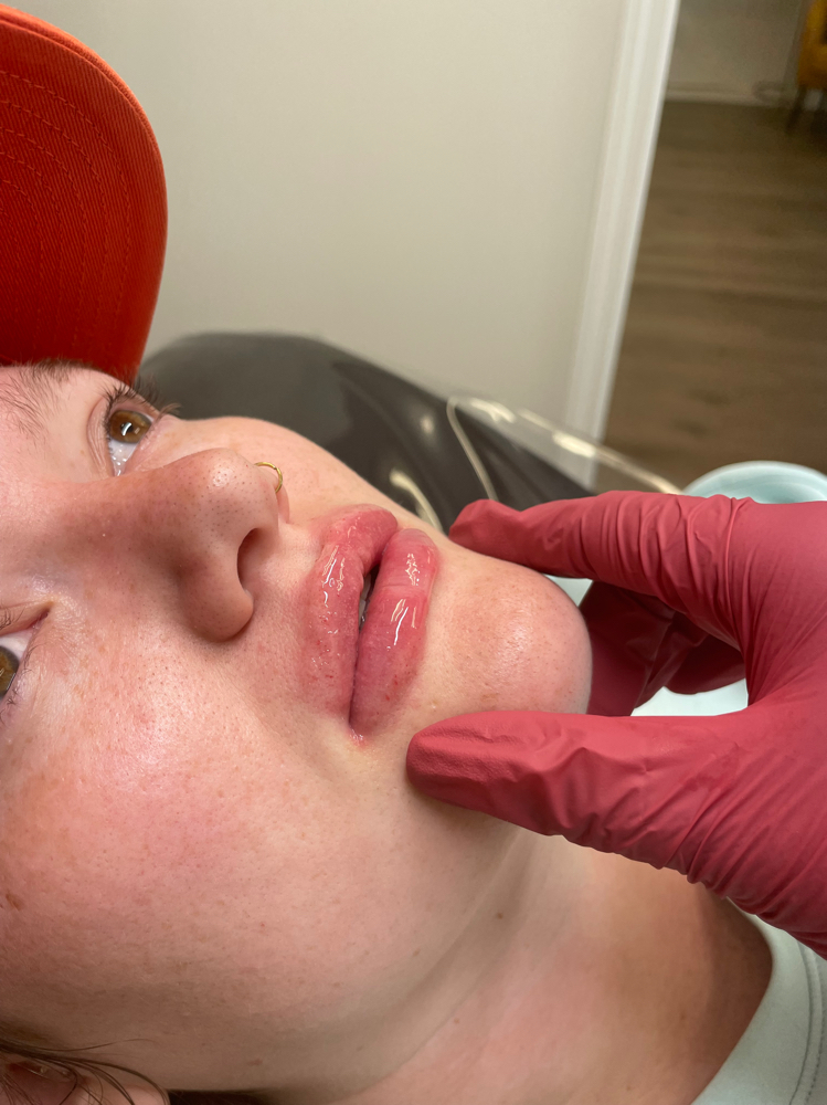 Hyaluronic Acid Lip fillers