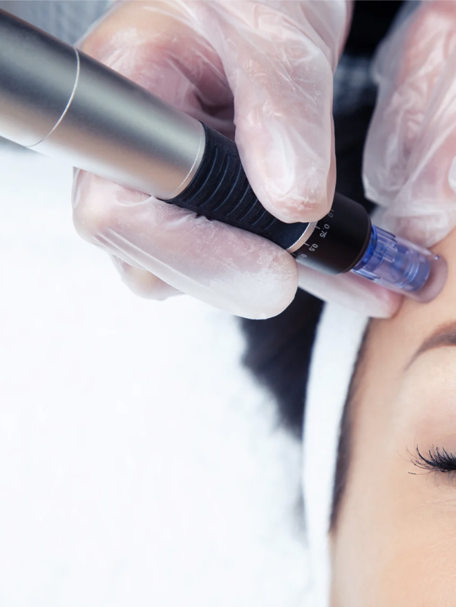 Microneedling Package- Set of 3 at Your Confident Skin in Ladera Ranch, CA