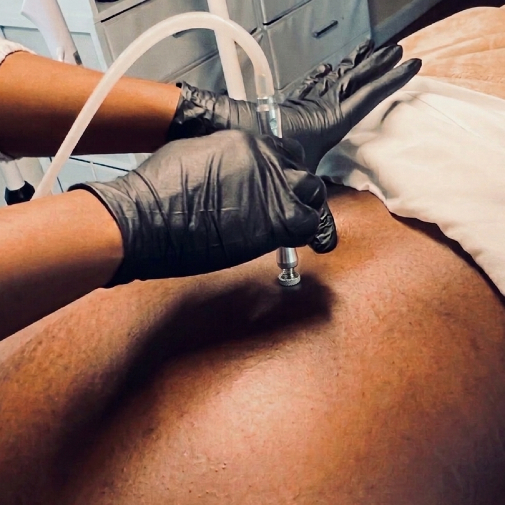 Microdermabrasion- Back Treatment at Skin by Amile in Oxon Hill, MD