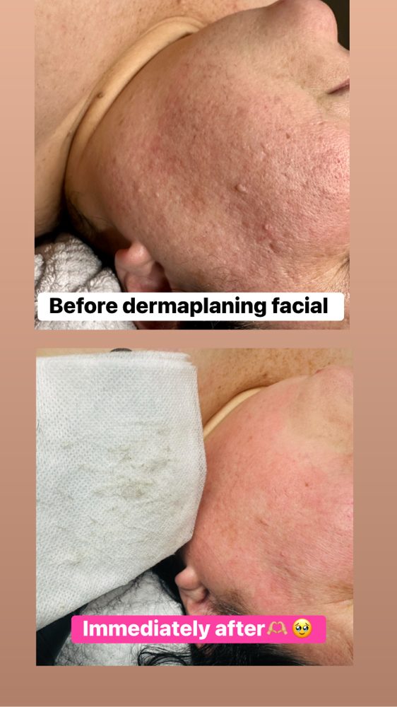 Dermaplaing **ADD ON ONLY at Ciao Bellä Esthetics WNC in Asheville, NC
