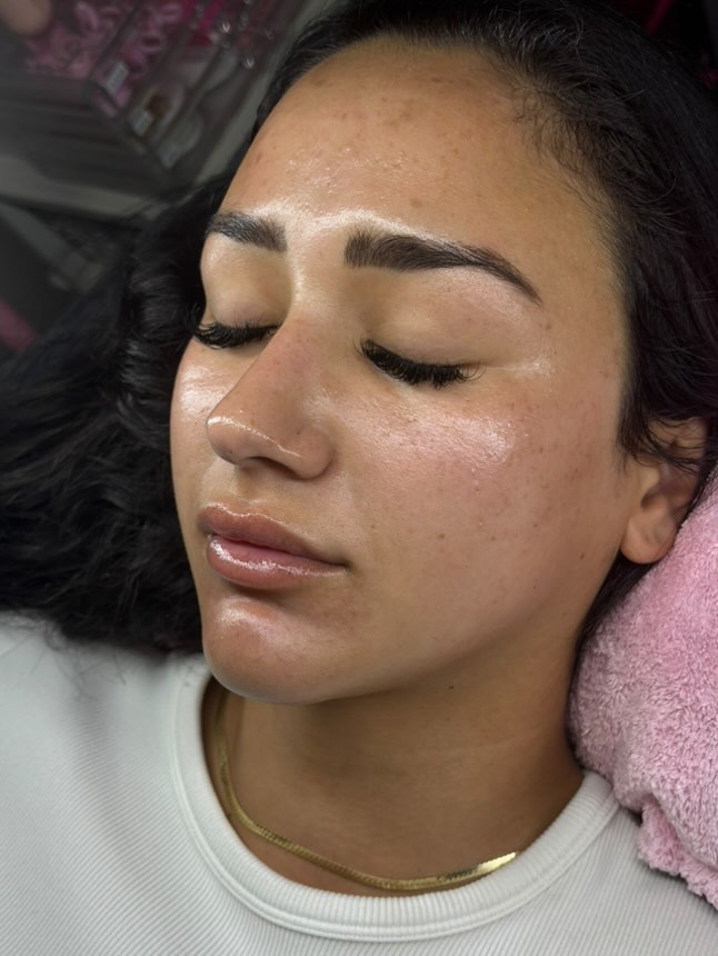 Dermaplaning