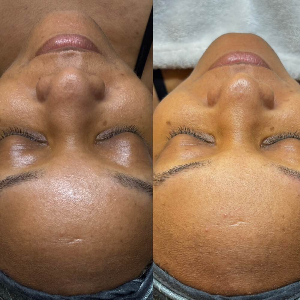PRO LuminFusion Treatment