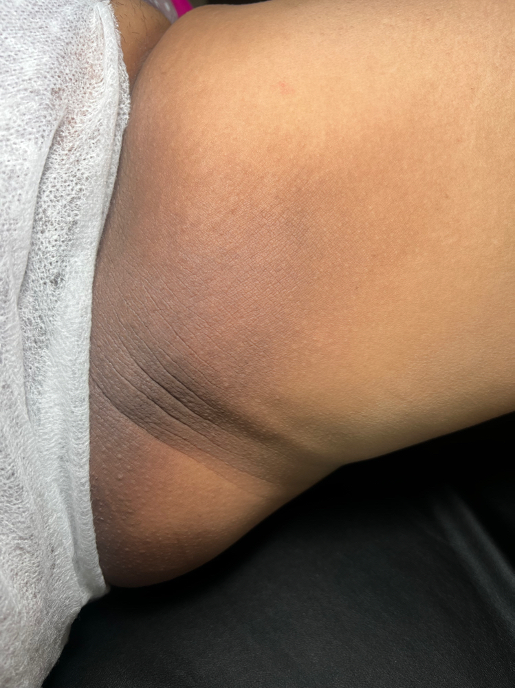 Inner Thighs (1 Treatment)