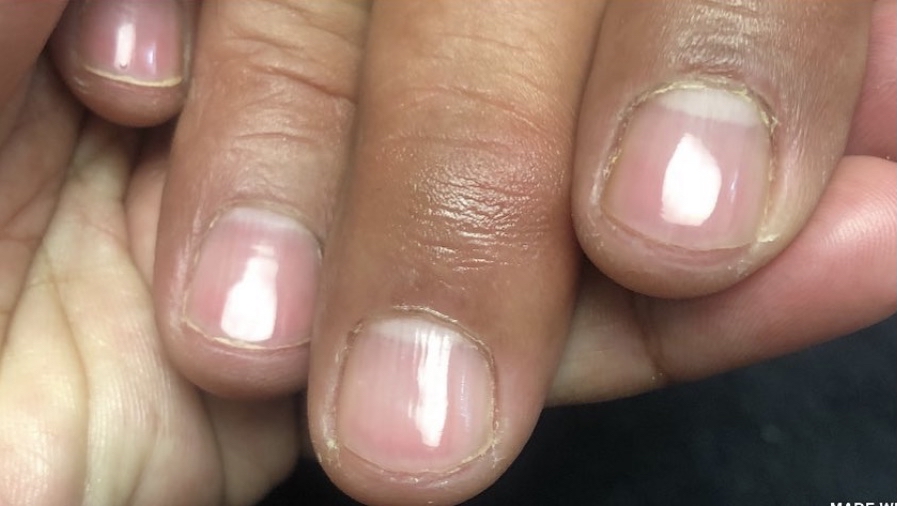 NAIL REPAIR