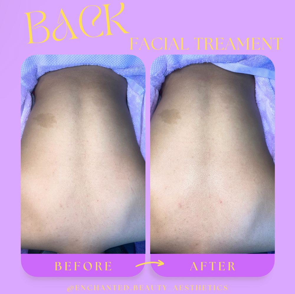 Back Facial