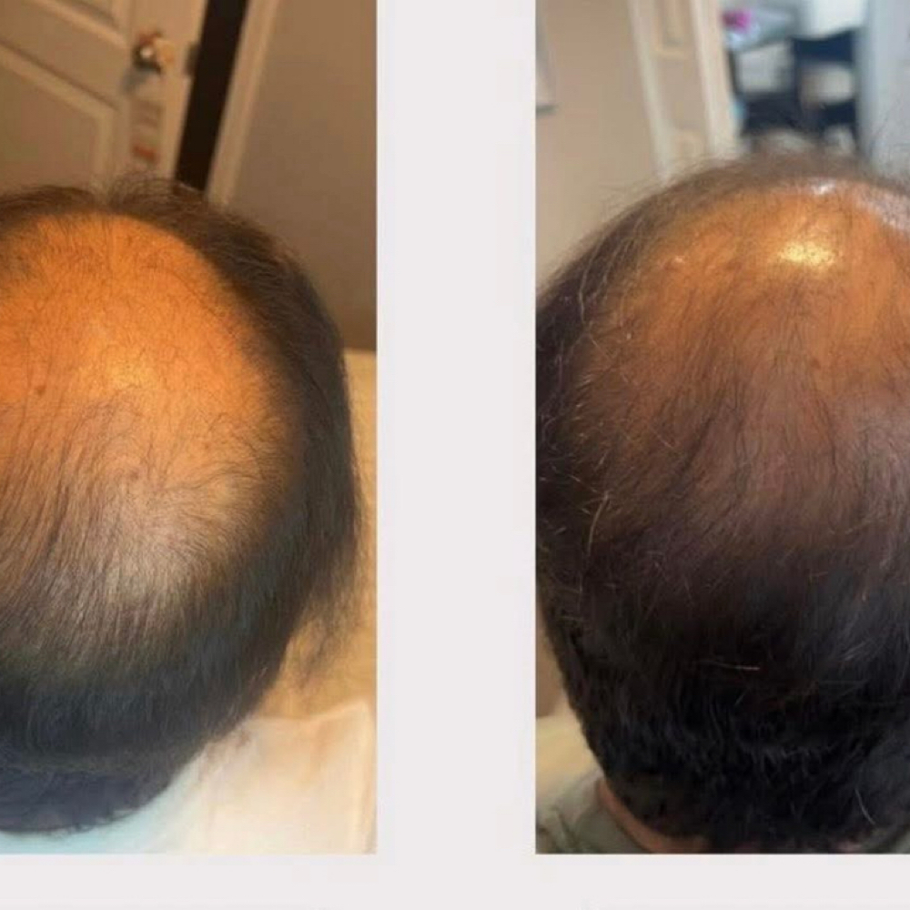 Hair Restore (Mesotherapy &Celluma at Lisa’s Lil Spa Room in Sioux Falls, SD