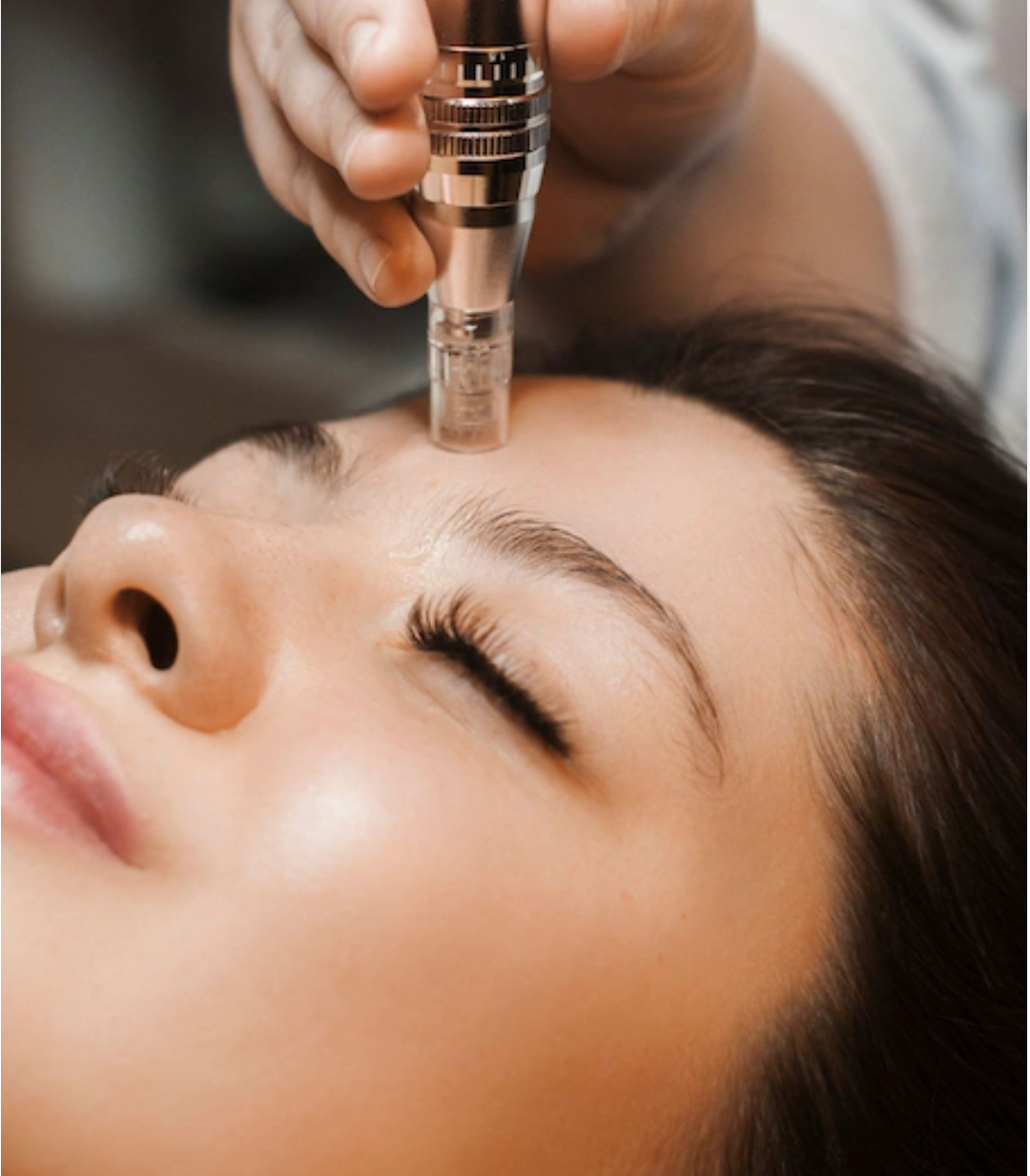Micro Needling series of 3