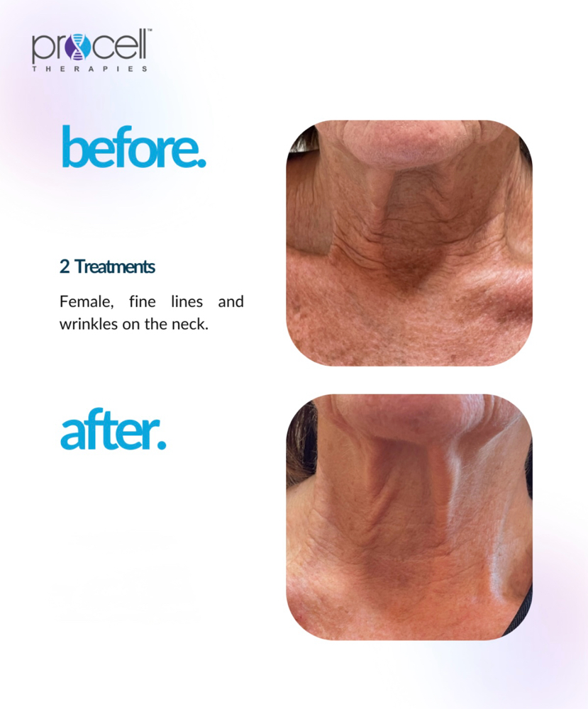 Procell Therapy Neck