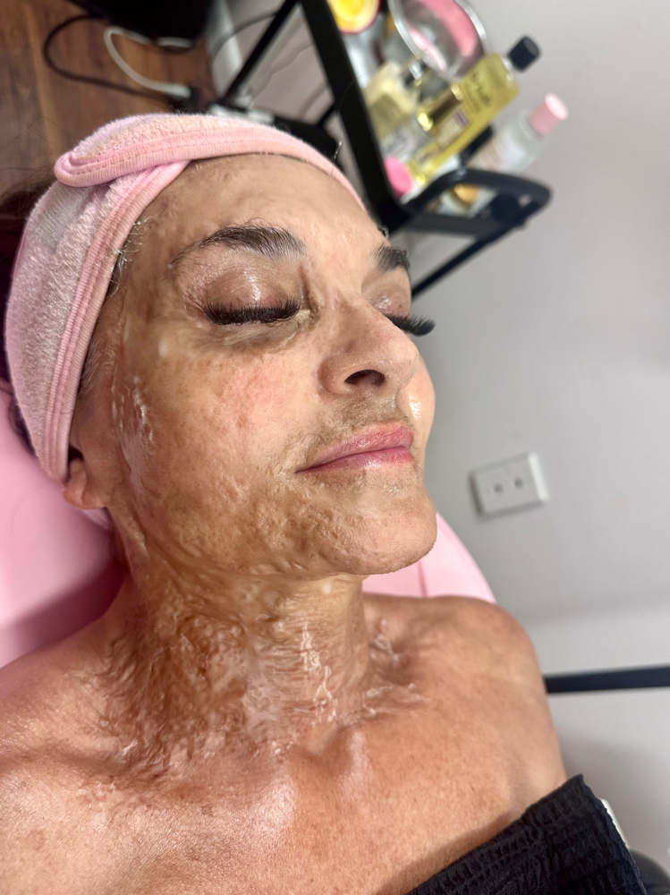 Botox Facial at All By Grace in Gilbert, WV