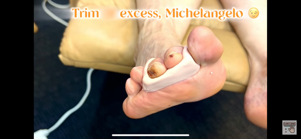 Better-feet Orthosis