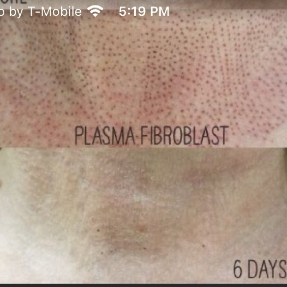 Plasma Fibroblast Neck Area at Glo’s Beauty Creations