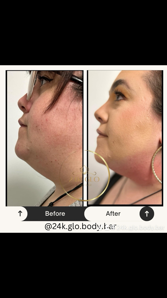 DOUBLE CHIN REDUCTION 6 Sessions