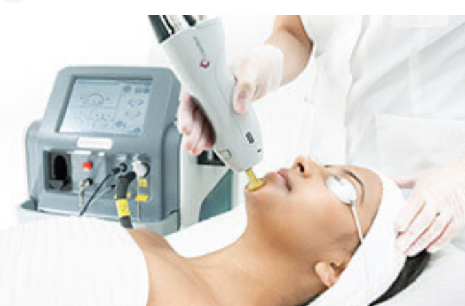 Laser Hair Removal Chin