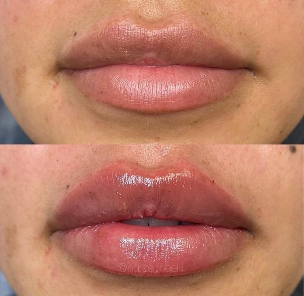Hyaluronic Lip Filler 1ml
