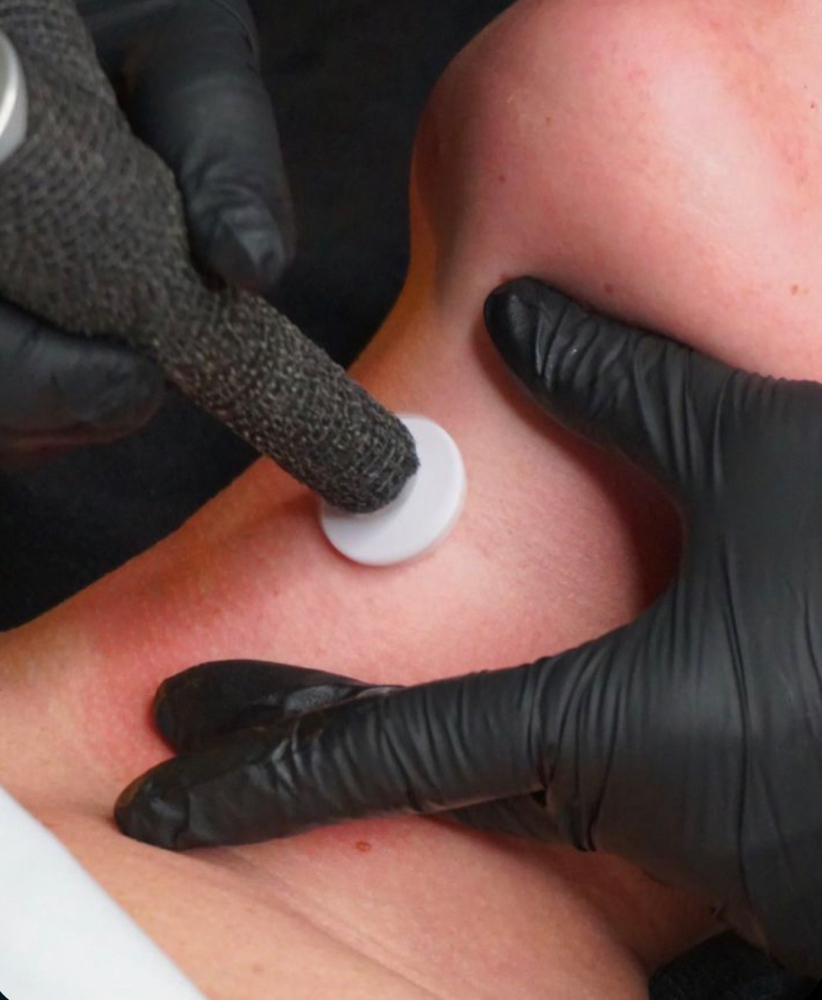 Micro-Channel Facial