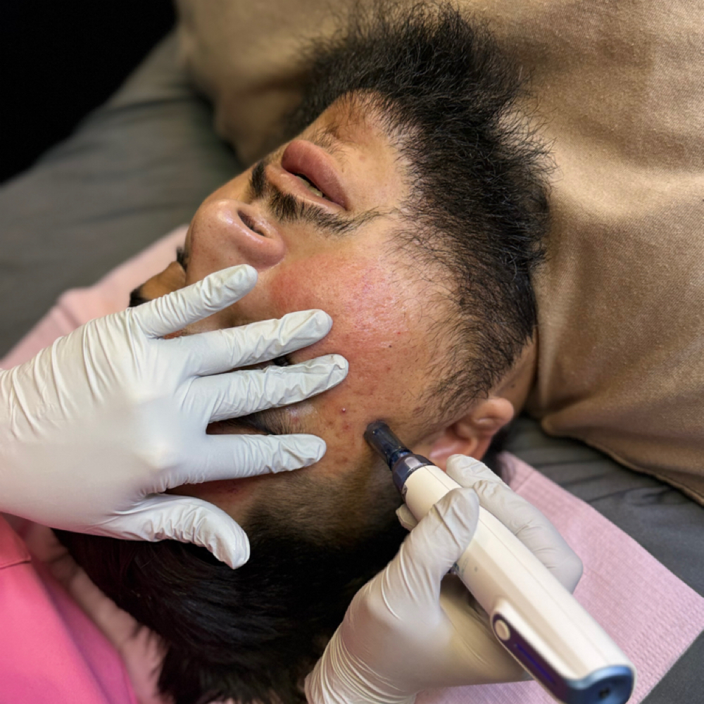 Microneedling at Megalife Skin & Beauty in Tempe, AZ