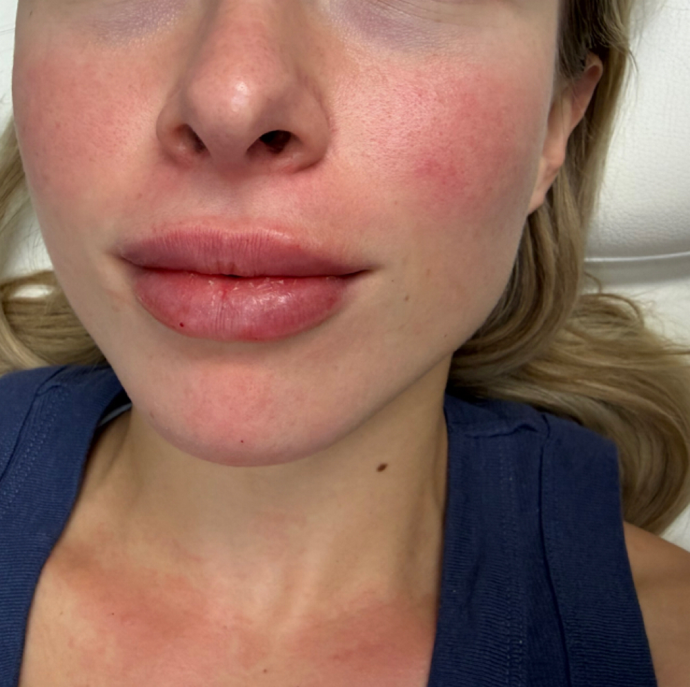 Lip Filler at Atelier Aesthetics and Infusions in Dallas, TX