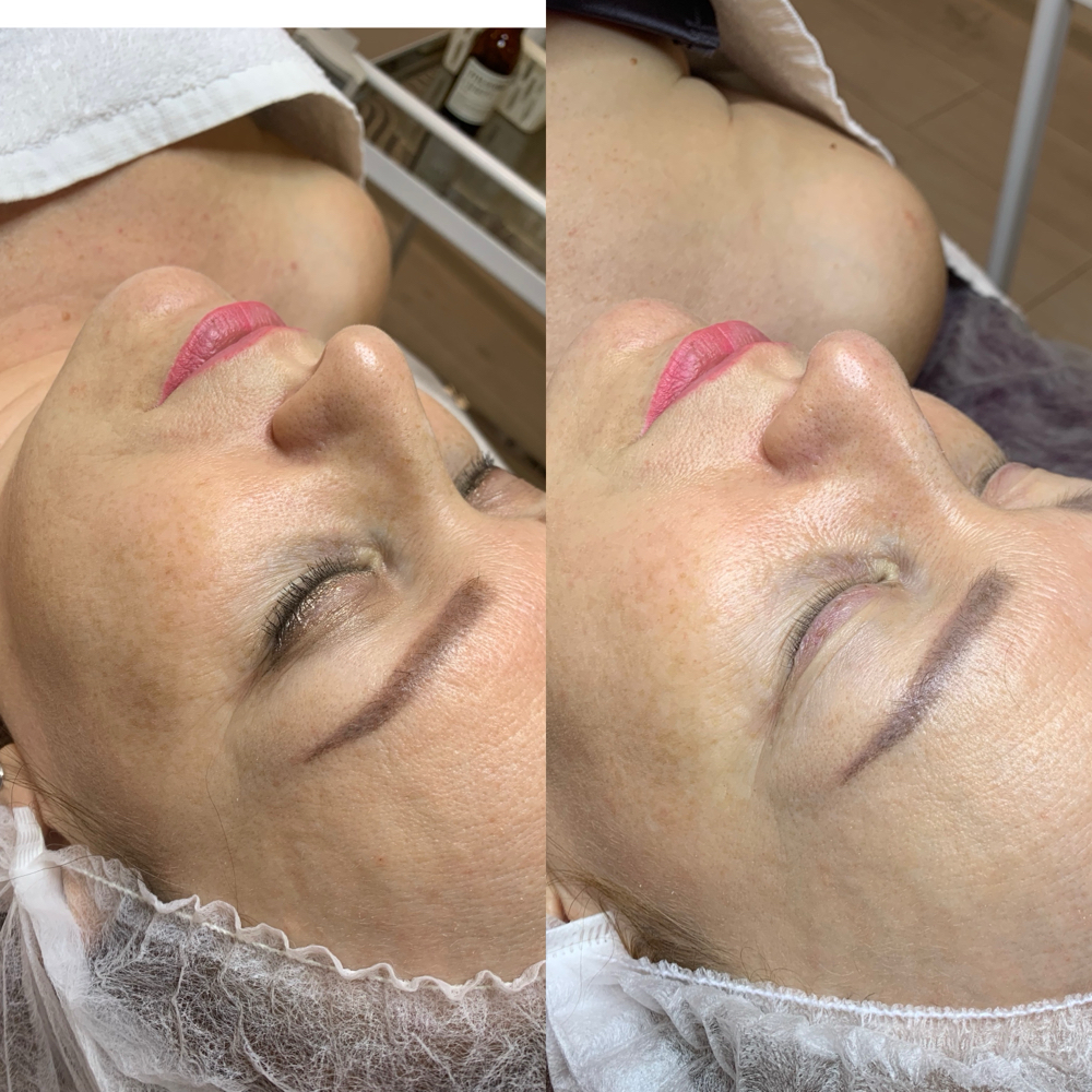 Superfacial Peel at Healthy skin by Alvina in Highland Park, IL