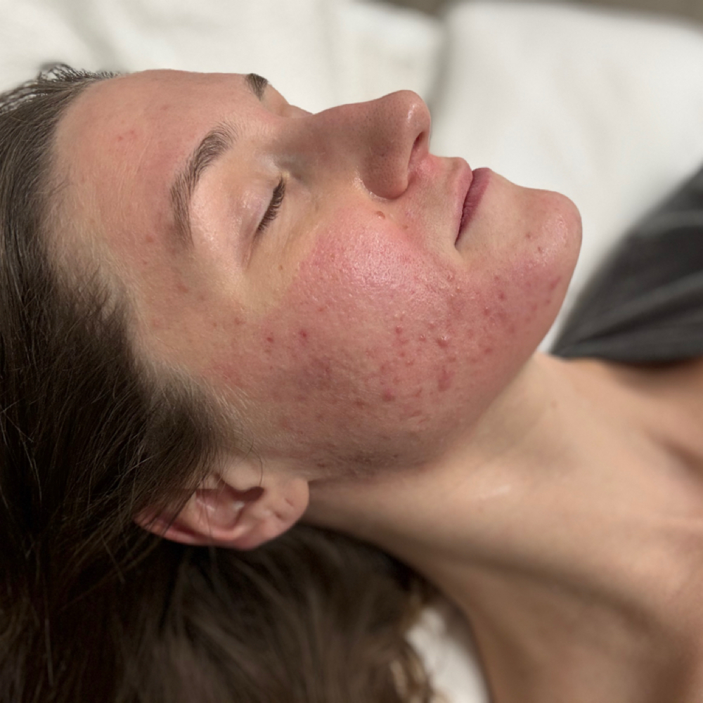 🧪Acne Support + Peel at ShannaLeigh Aesthetics in Boise, ID