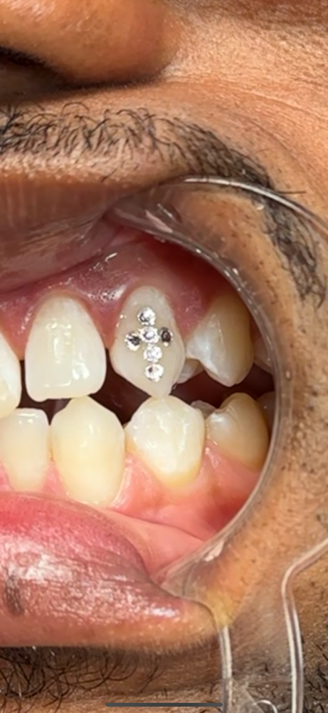 Custom Tooth Gem Design