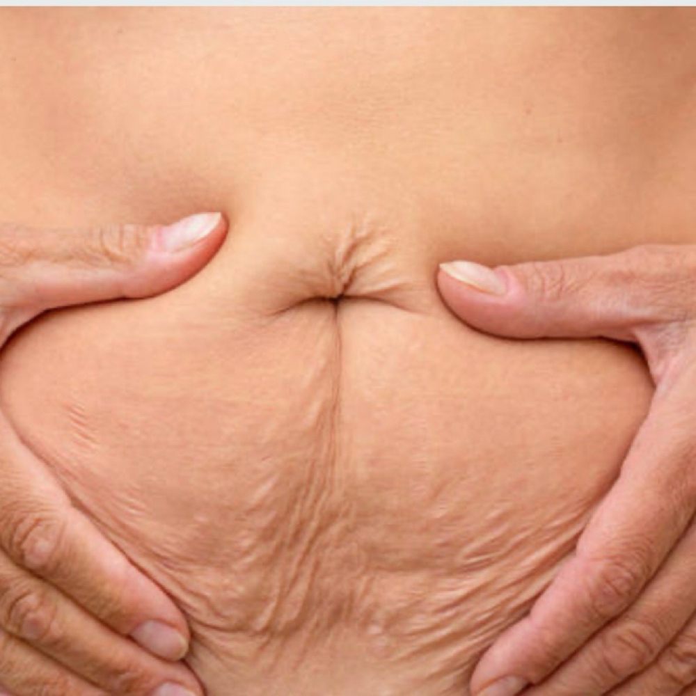 RF Skin Tightening | 1 Session at Hourglass Body Aesthetics in Green Bay, WI