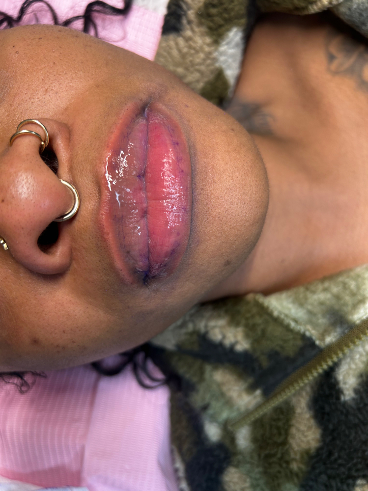 NEEDLE-LESS Lip Fillers 1.1ml