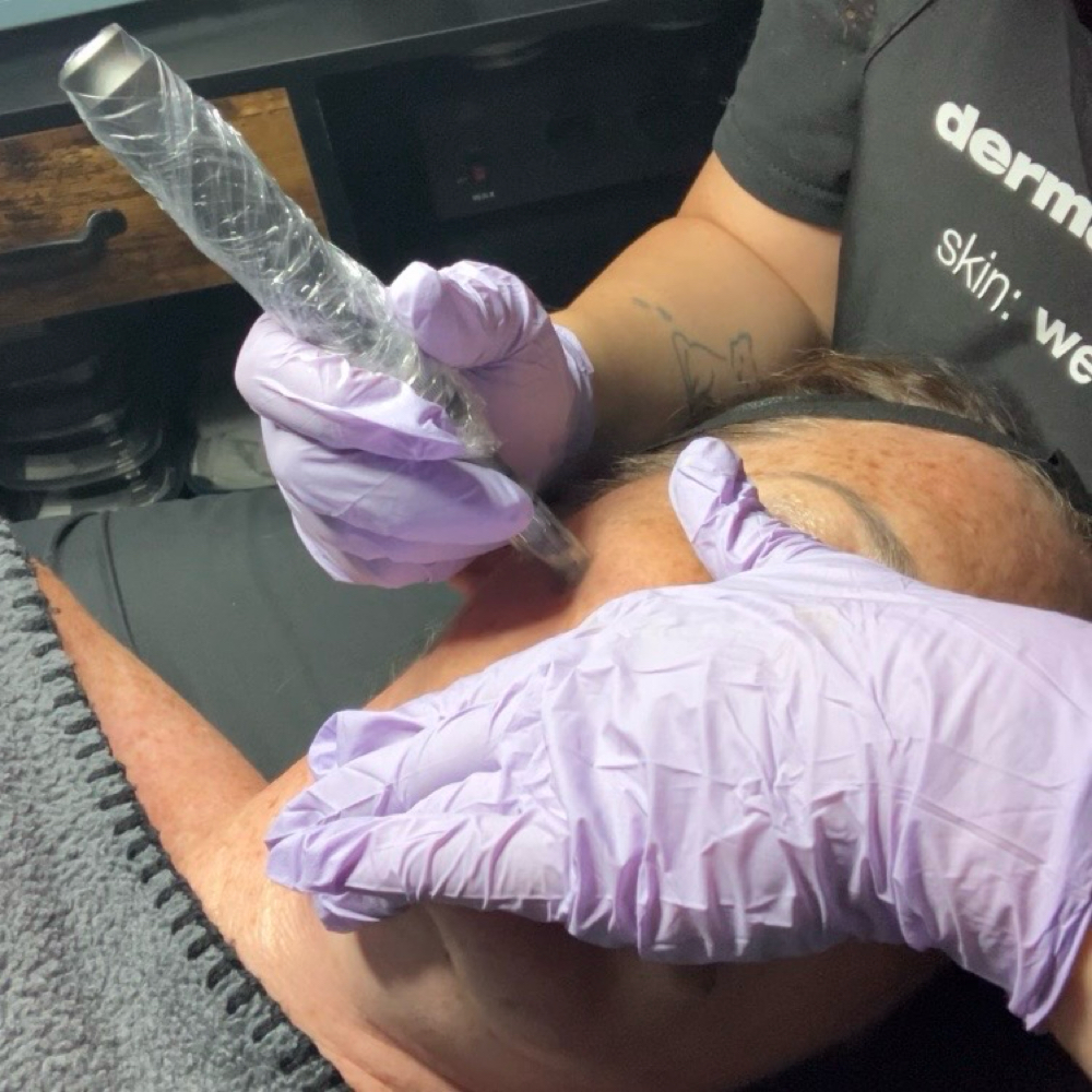 Microneedling at Golden Flower Esthetics in Weatherford, TX