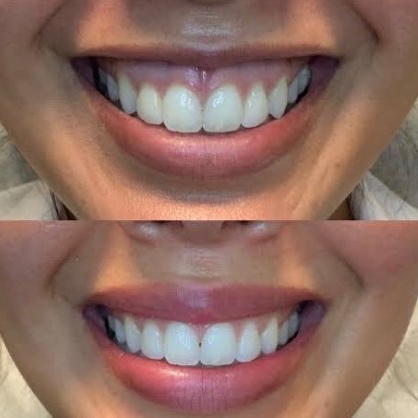 Lip Flip at Radiant Aesthetics by Liz in El Paso, TX