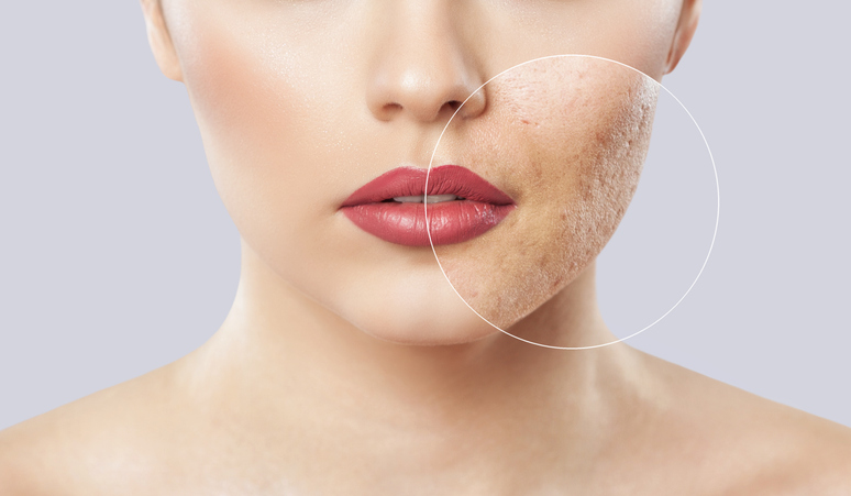 SKIN REPAIR – POST ACNE FACIAL