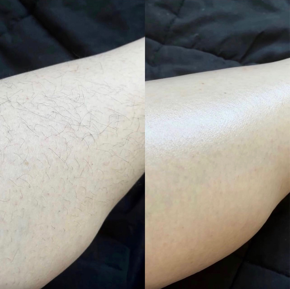 Full Leg Sugaring