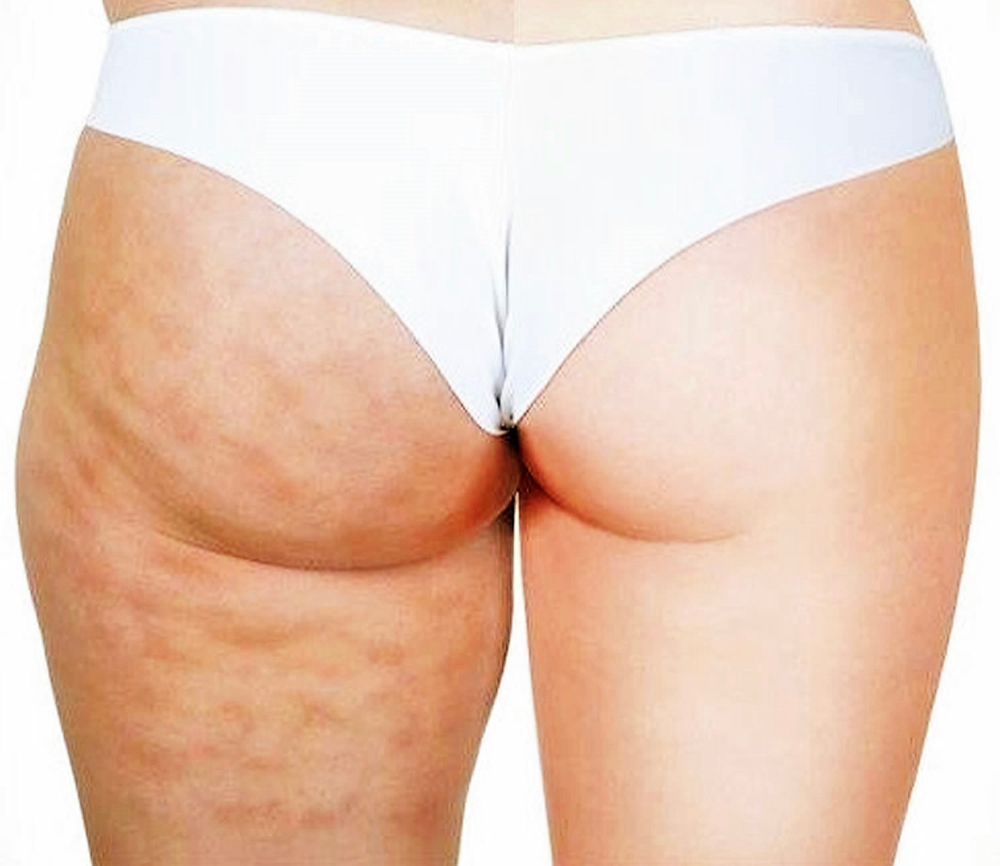 Cellulite Treatment
