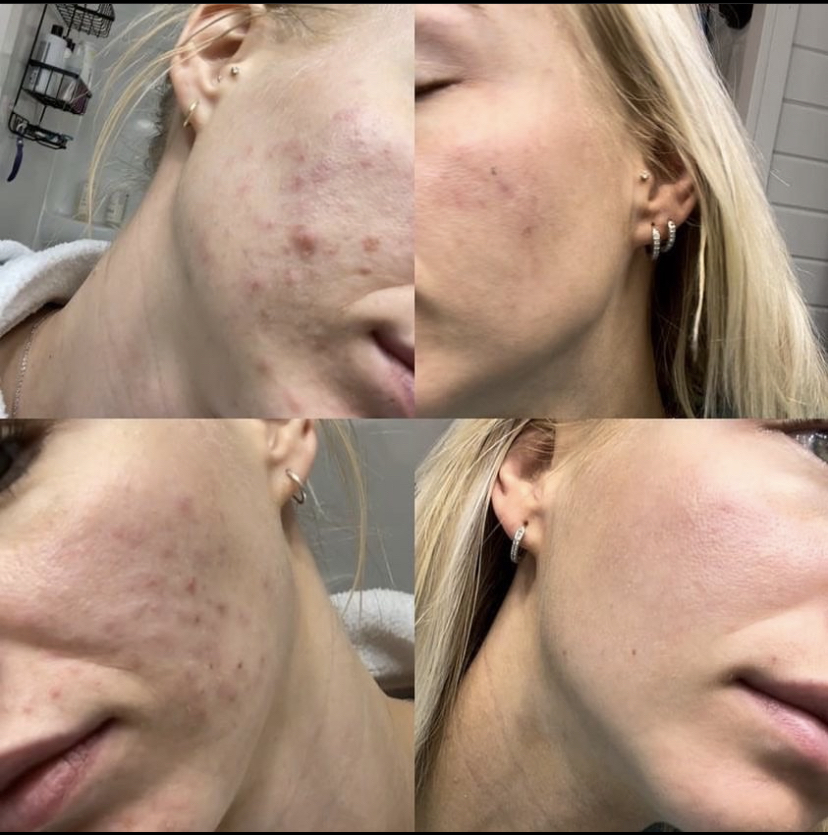 FaceReality Acne Treatments
