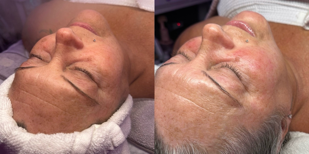 Lactic Acid Peel Facial