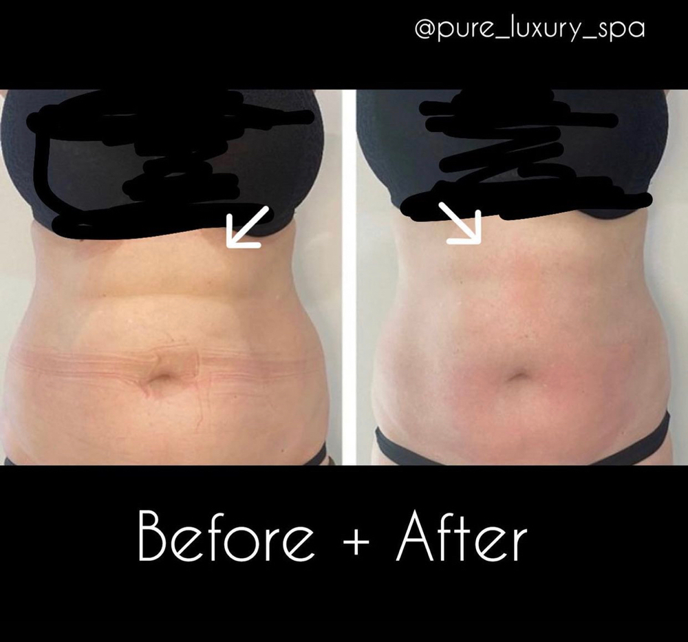 FAT & CELLULITE REDUCTION TREATMENT