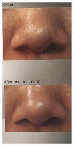 Detox Pore Treatment