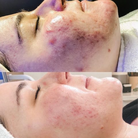 High Frequency Facial