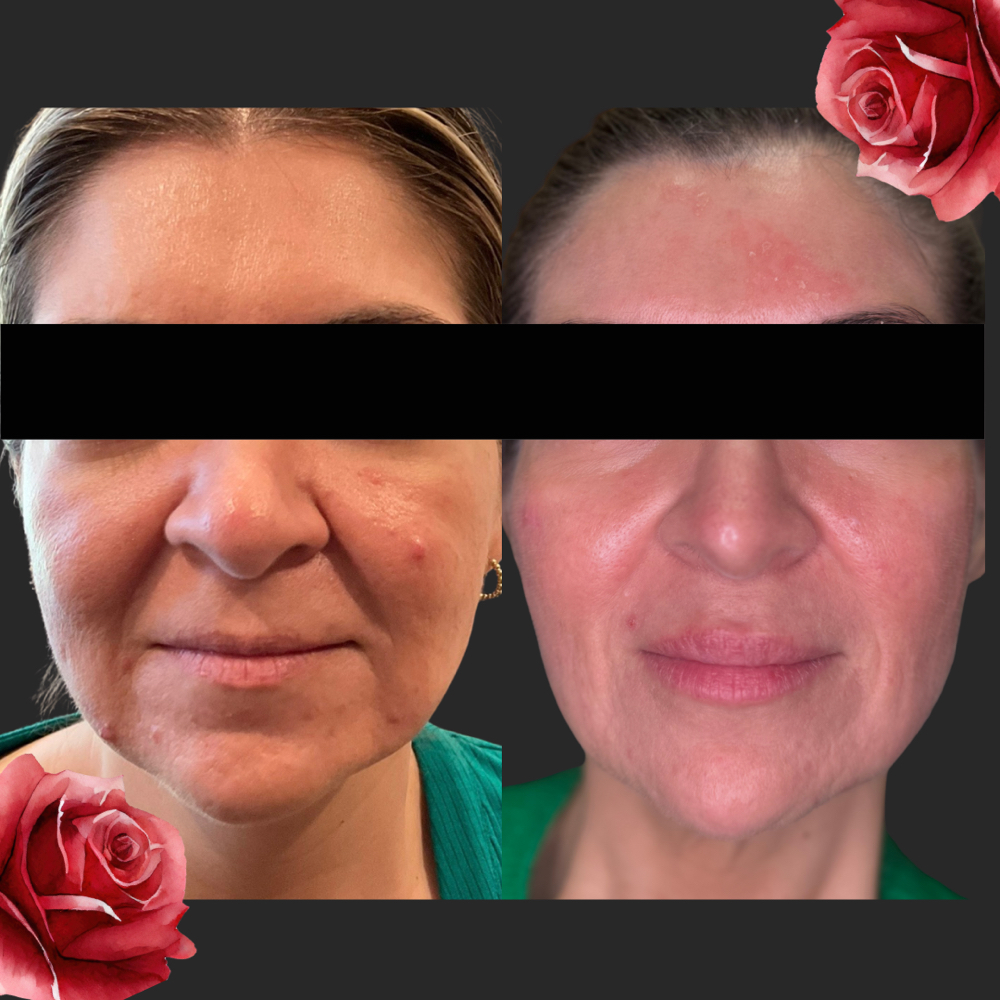 Biostimulators at Forever Young Beauty RN in Rowlett, TX