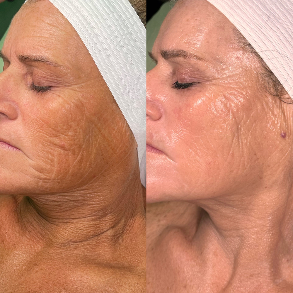 ProCell Therapies at Alt Aligned Skin in Dallas, TX