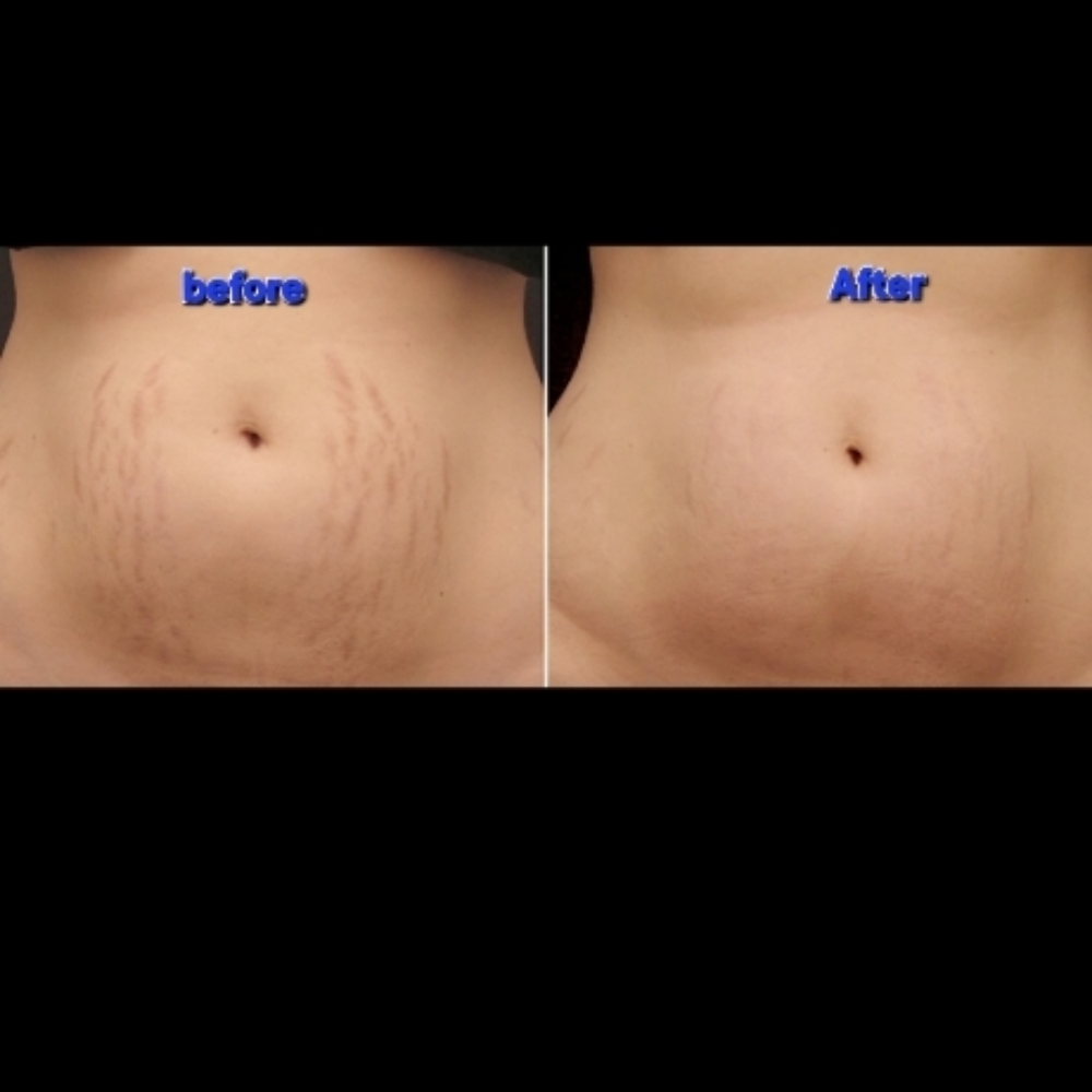 2 Stretch Mark Breakdown Bundle 2