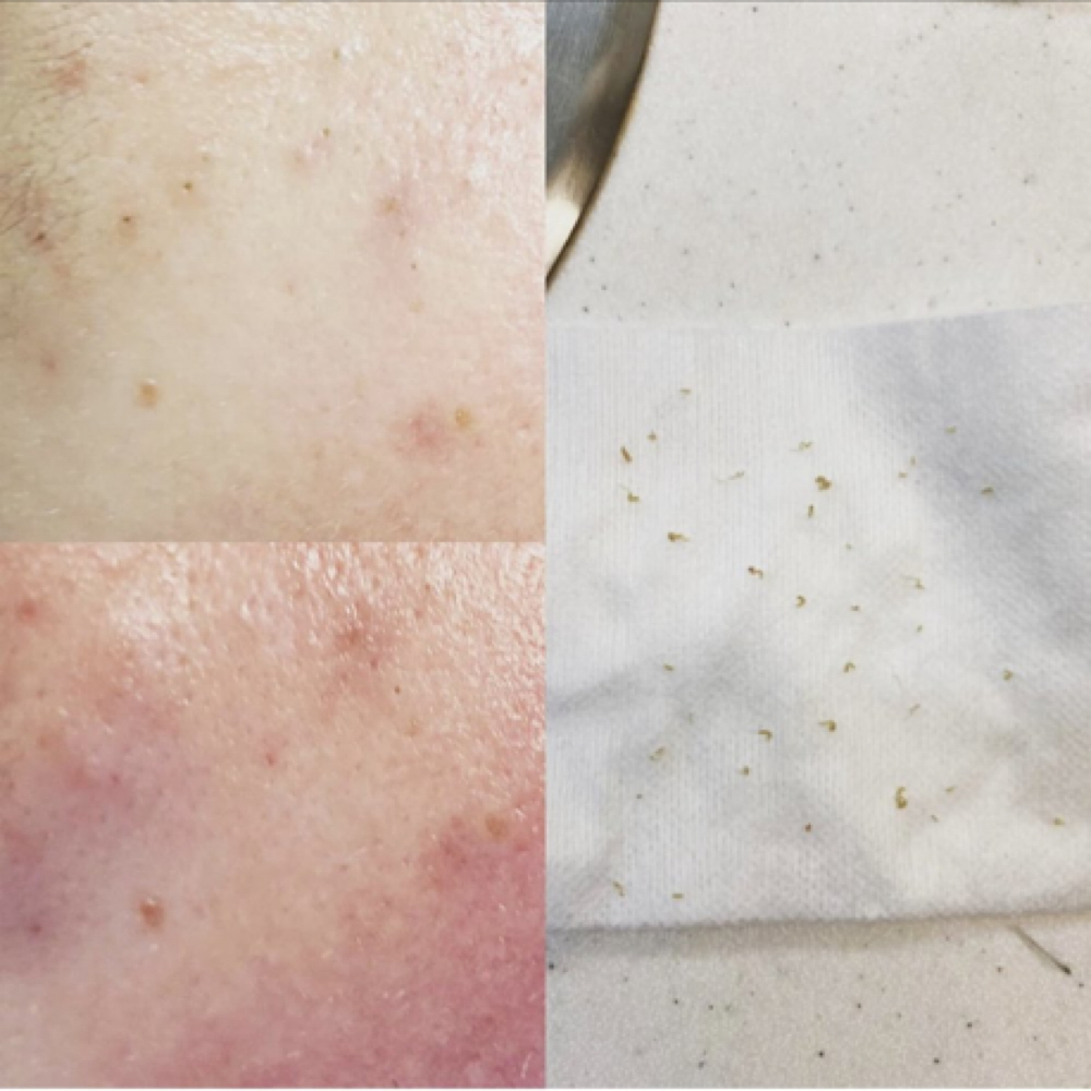 Extractions at SKIN by Christine Russell in Green Bay, WI